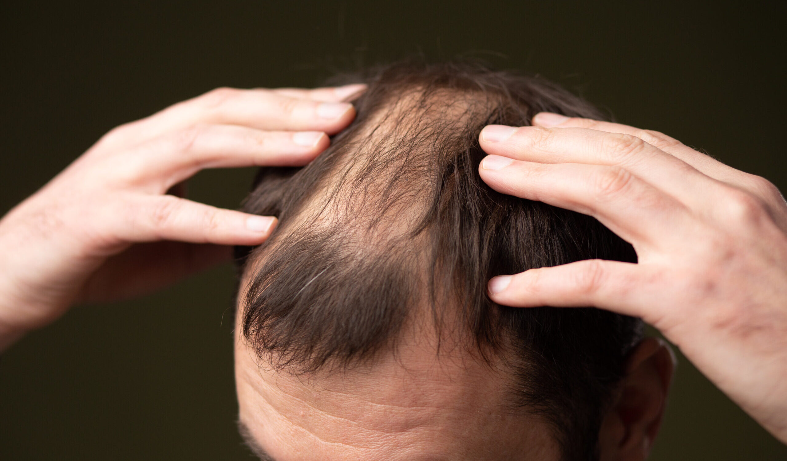 male hair pattern